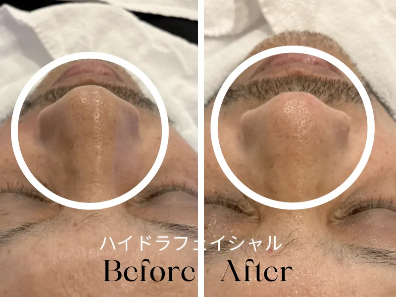 Male client's nose before and after a HydraFacial