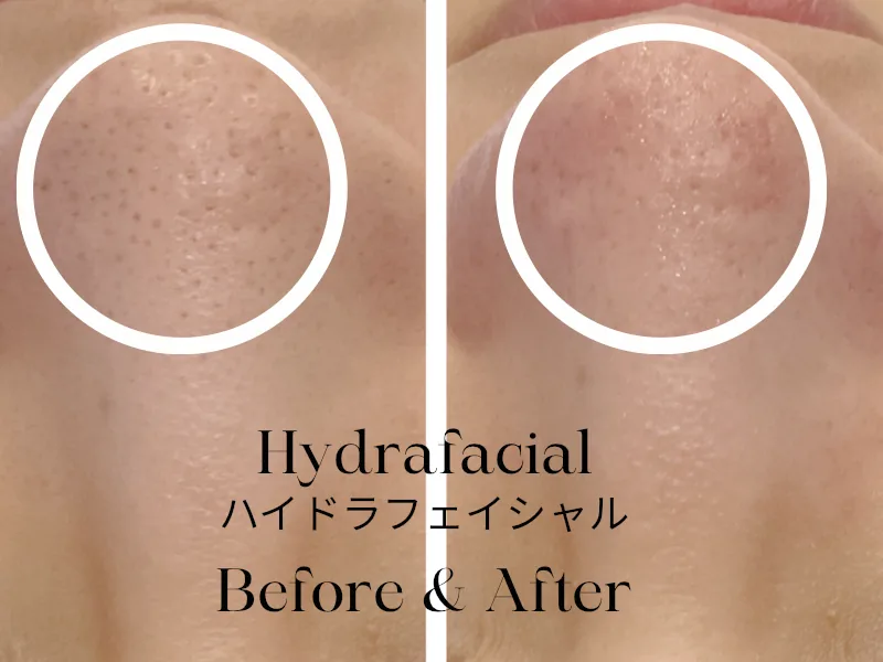 Nose before and after a HydraFacial — congested pores