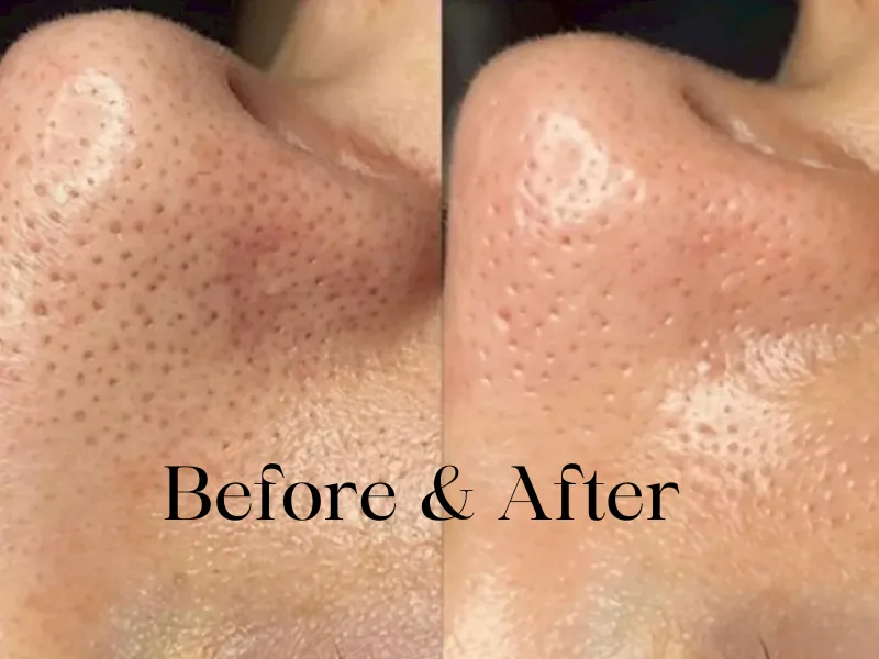 Nose before and after a HydraFacial — blackheads and clogged pores