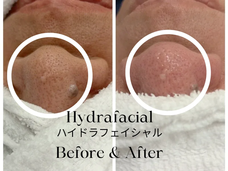 Nose before and after a HydraFacial — blackheads