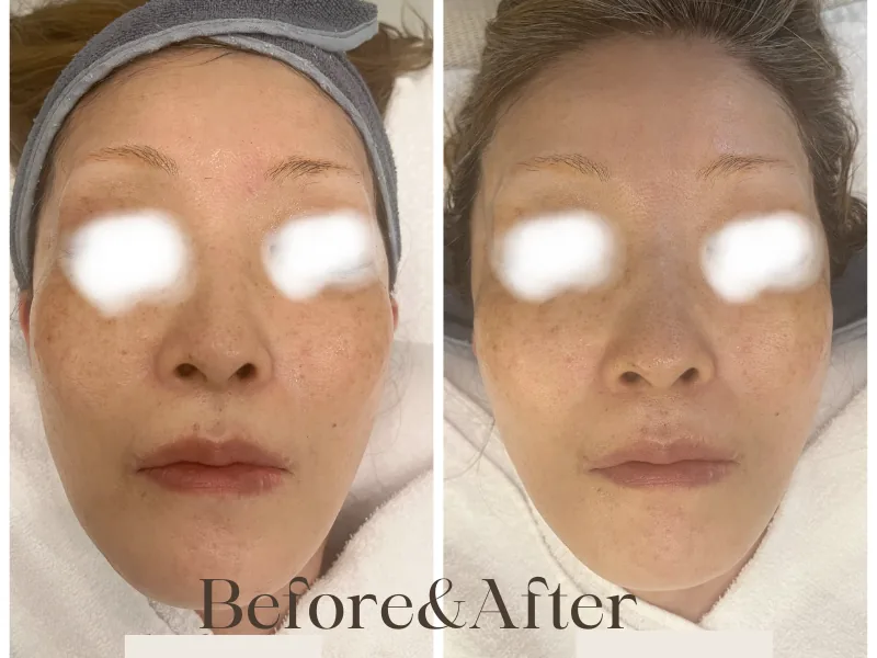 Face before and after a Snow Peel — uneven tone and dark spots